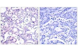 Immunohistochemical analysis of paraffin-embedded human breast carcinoma tissue using NF-κB p105/p50 (Ab-893) antibody (E021018). (NFKB1 抗体)