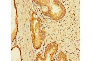 Immunohistochemistry of paraffin-embedded human prostate cancer using ABIN7156421 at dilution of 1:100 (INTS9 抗体  (AA 368-658))