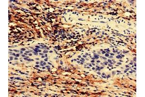 Immunohistochemistry analysis of human bladder cancer using ABIN7171814 at dilution of 1:100 (TEX43 抗体  (AA 1-134))
