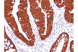 Formalin-fixed, paraffin-embedded colon carcinoma stained with Cytokeratin 19 Mouse Monoclonal Antibody (A53-B/A2. (Cytokeratin 19 抗体)