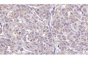 ABIN6278898 at 1/100 staining Human Melanoma tissue by IHC-P. (IL28B 抗体)