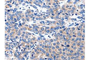 The image on the left is immunohistochemistry of paraffin-embedded Human liver cancer tissue using ABIN7191181(KCNH8 Antibody) at dilution 1/15, on the right is treated with synthetic peptide. (KCNH8 抗体)