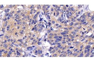 Detection of CASP9 in Human Lymphoma Tissue using Polyclonal Antibody to Caspase 9 (CASP9) (Caspase 9 抗体  (AA 331-416))