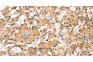 Immunohistochemistry of paraffin-embedded Human thyroid cancer tissue using STAM Polyclonal Antibody at dilution 1:40 (STAM 抗体)