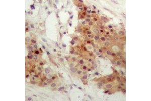 Immunohistochemical analysis of IRF3 (pS385) staining in human breast cancer formalin fixed paraffin embedded tissue section. (IRF3 抗体  (C-Term, pSer385))