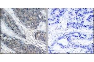 Immunohistochemistry analysis of paraffin-embedded human breast carcinoma, using IRS-1 (Phospho-Ser307) Antibody. (IRS1 抗体  (pSer307))