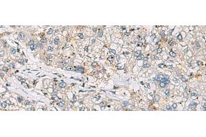 Immunohistochemistry of paraffin-embedded Human liver cancer tissue using ARIH1 Polyclonal Antibody at dilution of 1:30(x200) (ARIH1 抗体)