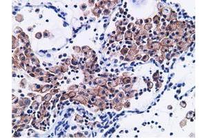 Immunohistochemical staining of paraffin-embedded Adenocarcinoma of Human breast tissue using anti-CD80 mouse monoclonal antibody. (CD80 抗体)