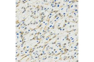 Immunohistochemistry of paraffin-embedded human kidney cancer tissue using MYSM1 antibody at dilution of 1:200 (x400 lens). (MYSM1 抗体  (C-Term))