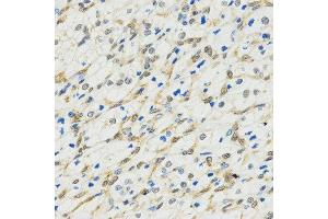Immunohistochemistry of paraffin-embedded human kidney cancer tissue using MYSM1 antibody at dilution of 1:200 (x400 lens).