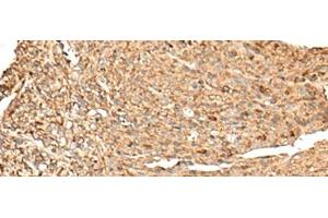 Immunohistochemistry of paraffin-embedded Human liver cancer tissue using RPS12 Polyclonal Antibody at dilution of 1:70(x200) (RPS12 抗体)