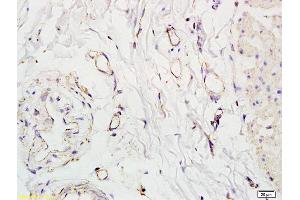 Formalin-fixed and paraffin embedded human colon carcinoma labeled with Anti-SLC5A8 Polyclonal Antibody, Unconjugated (ABIN762521) at 1:200 followed by conjugation to the secondary antibody and DAB staining. (SLC5A8 抗体  (AA 301-400))