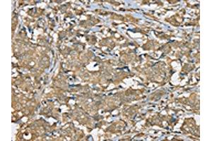 The image on the left is immunohistochemistry of paraffin-embedded Human breast cancer tissue using ABIN7192325(SERPINA11 Antibody) at dilution 1/35, on the right is treated with synthetic peptide. (SERPINA11 抗体)