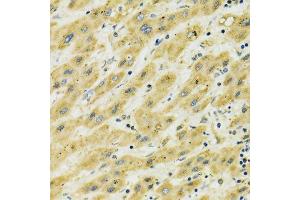 Immunohistochemistry of paraffin-embedded human liver cancer using HSPA9 antibody. (HSPA9 抗体  (AA 380-679))