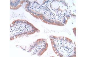 IHC-P analysis of Human Stomach Cancer Tissue, with DAB staining. (GLTP 抗体  (AA 2-209))