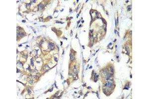 Immunohistochemistry of paraffin-embedded Human liver cancer using NFS1 Polyclonal Antibody at dilution of 1:100 (40x lens). (NFS1 抗体)