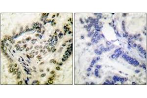 Immunohistochemistry analysis of paraffin-embedded human lung carcinoma, using CREB (Phospho-Ser142) Antibody. (CREB1 抗体  (pSer142))
