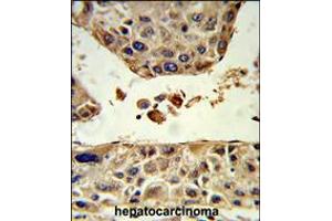 Formalin-fixed and paraffin-embedded human hepatocarcinoma reacted with HPD Antibody , which was peroxidase-conjugated to the secondary antibody, followed by DAB staining. (HPD 抗体  (C-Term))