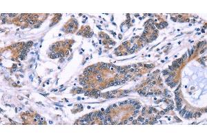 Immunohistochemistry of paraffin-embedded Human colon cancer using SYT4 Polyclonal Antibody at dilution of 1:60 (SYT4 抗体)