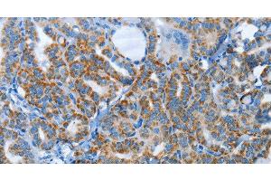 Immunohistochemistry of paraffin-embedded Human thyroid cancer tissue using AGL Polyclonal Antibody at dilution 1:30 (AGL 抗体)