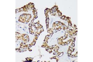 Immunohistochemistry of paraffin-embedded Human thyroid cancer using Septin 8 Rabbit pAb (ABIN7265350) at dilution of 1:100 (40x lens). (Septin 8 抗体  (AA 348-427))