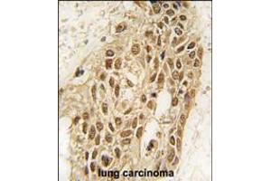 Formalin-fixed and paraffin-embedded human lung carcinoma tissue reacted with Dnmt3a antibody (N-term R46) , which was peroxidase-conjugated to the secondary antibody, followed by DAB staining. (DNMT3A 抗体  (N-Term))
