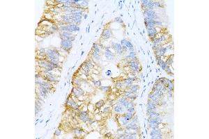 Immunohistochemistry of paraffin-embedded human colon carcinoma using BMP2 antibody at dilution of 1:100 (40x lens). (BMP2 抗体)
