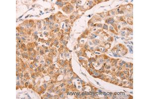 Immunohistochemistry of Human lung cancer using GNA11 Polyclonal Antibody at dilution of 1:40 (GNA11 抗体)