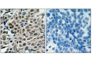 Immunohistochemical analysis of paraffin-embedded human breast carcinoma tissue using FKHRL1 (phospho-Ser253) antibody.