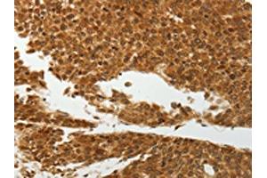 The image on the left is immunohistochemistry of paraffin-embedded Human liver cancer tissue using ABIN7192598(SOCS7 Antibody) at dilution 1/30, on the right is treated with synthetic peptide. (SOCS7 抗体)