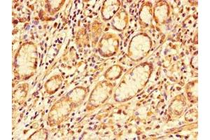 Immunohistochemistry of paraffin-embedded human gastric cancer using ABIN7163856 at dilution of 1:100 (GALNT11 抗体  (AA 420-606))