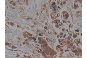 Detection of PKCi in Human Breast cancer Tissue using Polyclonal Antibody to Protein Kinase C Iota (PKCi) (PKC iota 抗体  (AA 375-596))