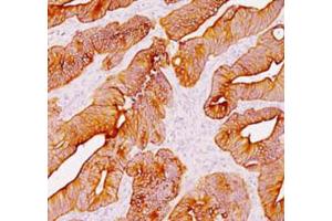 Immunohistochemical staining (Formalin-fixed paraffin-embedded sections) analysis of human colon with Pan Cytokeratin monoclonal antibody, clone AE1 + AE3  at 1:200 using peroxidase-conjugate and DAB chromogen. (Keratin 77 抗体)