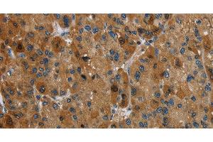 Immunohistochemistry of paraffin-embedded Human liver cancer tissue using HSD17B14 Polyclonal Antibody at dilution 1:40 (HSD17B14 抗体)