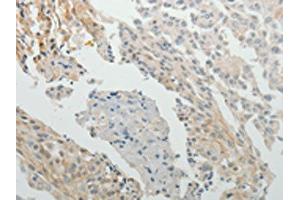 The image on the left is immunohistochemistry of paraffin-embedded Human cervical cancer tissue using ABIN7131158(SPATA17 Antibody) at dilution 1/15, on the right is treated with fusion protein. (SPATA17 抗体)