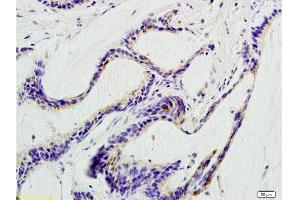 Formalin-fixed and paraffin embedded human colon carcinoma labeled with Anti-beta Defensin 1 Polyclonal Antibody, Unconjugated  at 1:200 followed by conjugation to the secondary antibody and DAB staining. (beta Defensin 1 抗体  (AA 33-68))
