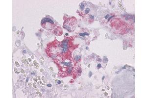 Anti-PTHR / PTHR1 antibody IHC of human Bone, Giant Cell Tumor. (PTH1R 抗体  (N-Term))