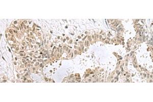 Immunohistochemistry of paraffin-embedded Human breast cancer tissue using PCBD1 Polyclonal Antibody at dilution of 1:60(x200) (PCBD1 抗体)