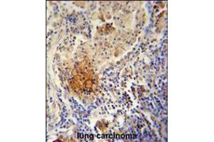 TYROBP Antibody immunohistochemistry analysis in formalin fixed and paraffin embedded human lung carcinoma followed by peroxidase conjugation of the secondary antibody and DAB staining. (TYROBP 抗体  (C-Term))