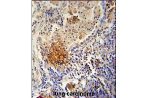TYROBP Antibody immunohistochemistry analysis in formalin fixed and paraffin embedded human lung carcinoma followed by peroxidase conjugation of the secondary antibody and DAB staining.