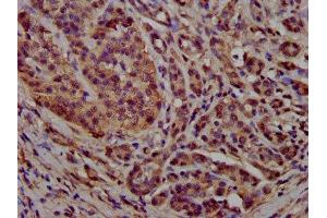 IHC image of ABIN7164816 diluted at 1:300 and staining in paraffin-embedded human pancreatic cancer performed on a Leica BondTM system. (PCCB 抗体  (AA 200-314))