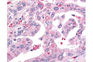 Anti-USP4 / UNP antibody IHC of human Pancreas, Carcinoma. (USP4 抗体  (Internal Region))