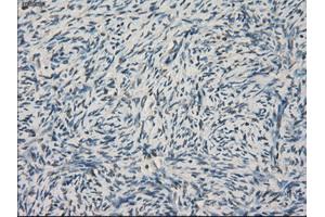 Immunohistochemical staining of paraffin-embedded Adenocarcinoma of colon tissue using anti-LTA4H mouse monoclonal antibody. (LTA4H 抗体)