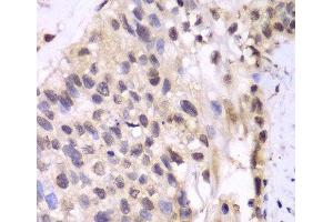 Immunohistochemistry of paraffin-embedded Human lung cancer using PSMA6 Polyclonal Antibody at dilution of 1:100 (40x lens). (PSMA6 抗体)