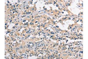 The image on the left is immunohistochemistry of paraffin-embedded Human thyroid cancer tissue using ABIN7190272(CLDN11 Antibody) at dilution 1/25, on the right is treated with synthetic peptide. (Claudin 11 抗体)