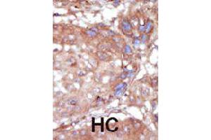 Formalin-fixed and paraffin-embedded human hepatocellular carcinoma tissue reacted with TNK2 polyclonal antibody  , which was peroxidase-conjugated to the secondary antibody, followed by AEC staining. (TNK2 抗体  (C-Term))