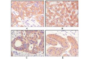Immunohistochemical analysis of paraffin-embedded human lung squamous cell carcinoma (A),normal hepatocyte (B), colon adenocacinoma? (Cytokeratin 1 抗体)