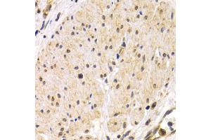 Immunohistochemistry of paraffin-embedded human stomach cancer using TMPRSS2 antibody. (TMPRSS2 抗体)