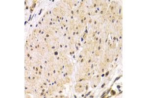 Immunohistochemistry of paraffin-embedded human stomach cancer using TMPRSS2 antibody. (TMPRSS2 抗体)