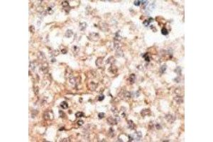 IHC analysis of FFPE human hepatocarcinoma tissue stained with the Osteocalcin antibody (Osteocalcin 抗体  (AA 2-32))